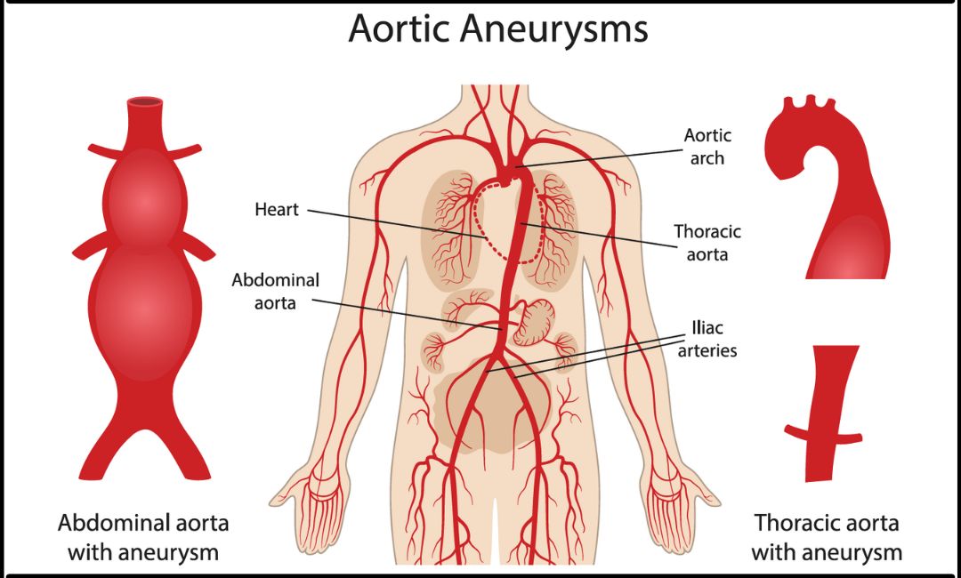 Aortic aneurysm 